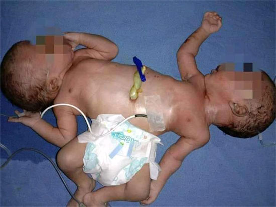 शाहजहांपुर : महिला ने चार हांथ, दो पैर और दो सिर वाले बच्चे को दिया जन्म