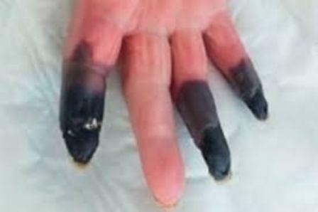 कोरोना का खतरनाक रूप, महिला की काली पड़ी उंगलियां डॉक्टर ने काटी 