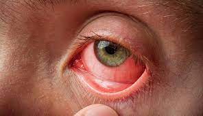 आइए जानते हैं किस वजह से होता है आंखों का संक्रमण इसके बचाव और उपचार के बारे में ..... 
