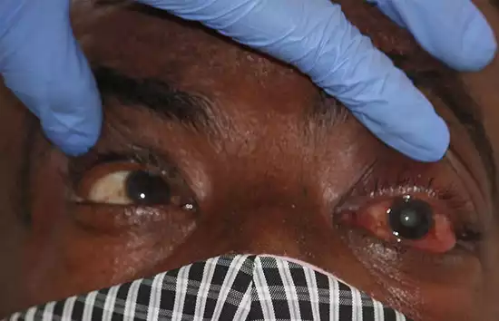 बाराबंकी : ब्लैक फंगस का दूसरा मरीज मिलने से हड़कंप, पीजीआई रेफर करने की तैयारी 