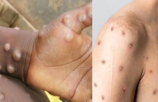देश में मंकीपॉक्स के बढ़ते मामलों ने बढ़ाई चिंता, जाने क्या इसकी पहचान और बचाव ? 